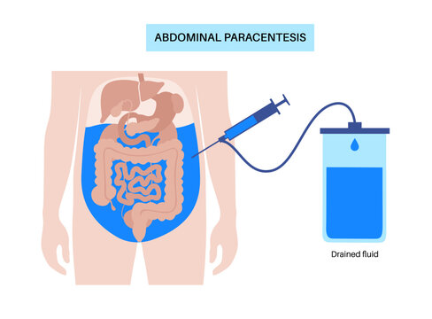 Abdominal paracentesis poster