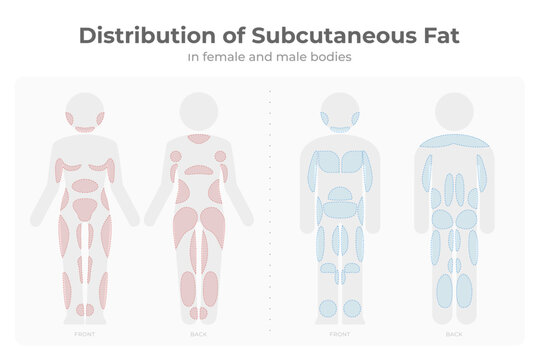 Subcutaneous fat distribution in men and women pictogram.
Vector infographic medical of fat mass areas in male and female body.
Target areas for diet treatment, liposuction, fat freezing liposculpture