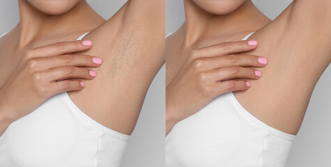 Before and after epilation. Collage with photos of woman showing armpit on light background, closeup