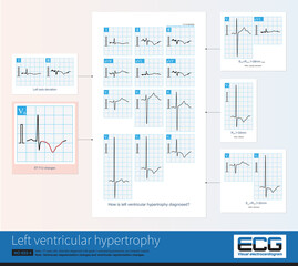 Common ECG changes in left ventricular hypertrophy include increased amplitude of QRS waves, ST-T changes, U-wave changes, left axis deviation, and left atrial abnormality.