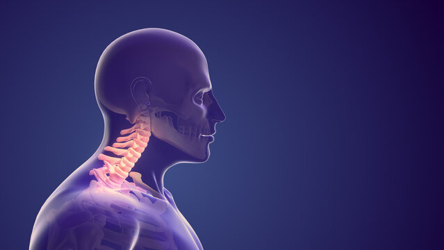 Cervical posture syndrome or neck discomfort