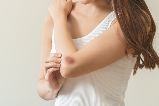 Close up of stain bruise wound on arm, contusion asian young woman, girl an accident fell down stairs, hand on elbow in healing injury by massage hematoma blood. Extravasation blue, purple on skin.