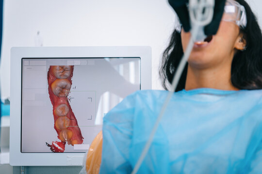 3D AI scanning of teeth