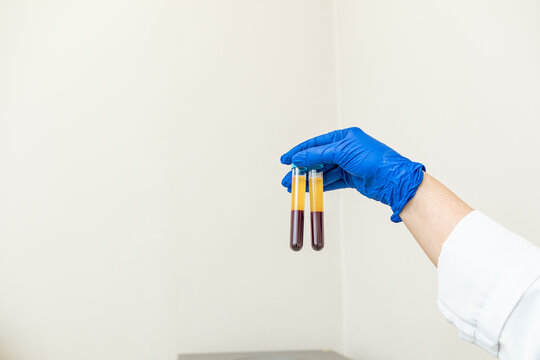 doctor showing the plasma specimens extracted from the machine