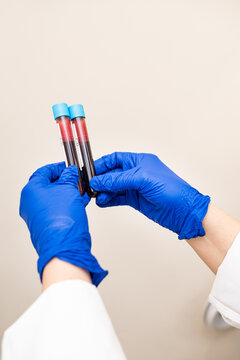 test tubes of blood collected from the patient