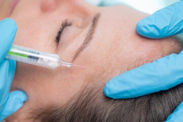 Treating forehead lines with hyaluronic acid filler, a dermatology treatment that targets forehead...