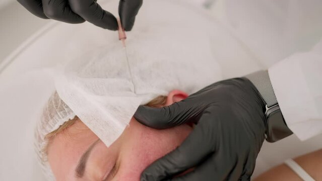 The procedure of lifting the face using special threads.