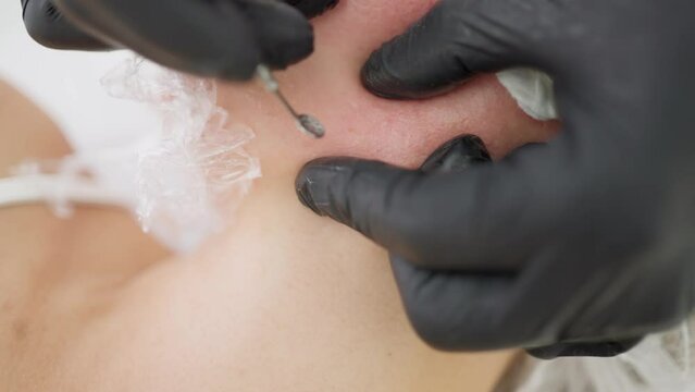 A close-up of the client's face during the cleaning of comedones