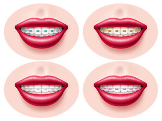 Obraz premium Realistic teeth dental braces. Smiling lips, orthodontic bite correction, tightening structures, different types metal, ceramic and sapphire, , health and beauty utter png 3d isolated set