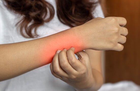 Asian woman scratching lower arm. Itchy skin diseases such as scabies, fungal infection, rash, etc.