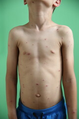 Chickenpox blisters on child body symptoms of varicella disease 