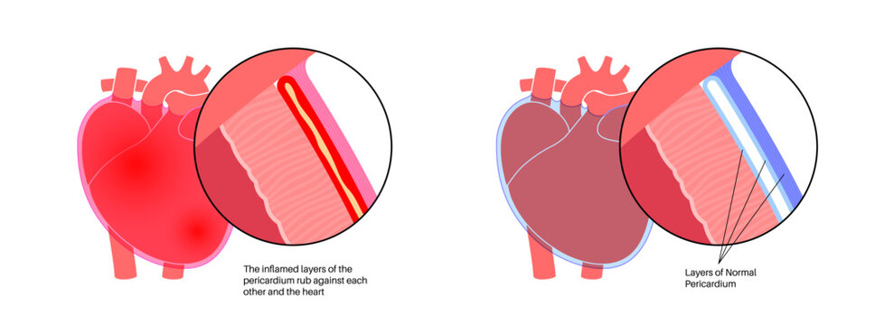 Pericarditis heart disease