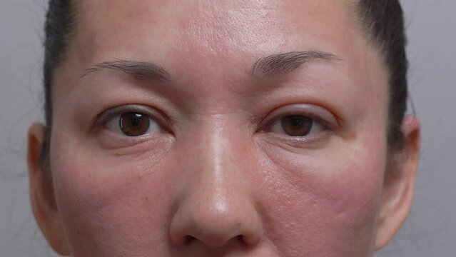 allergies, rosacea, rosacea, redness of the skin, red spots on the cheeks, a woman with sensitive skin, a close-up of the patient's face