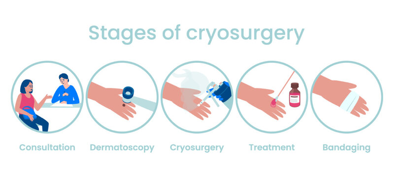 Stages of the cryosurgery procedure in the treatment of skin neoplasms. Consultation, dermatoscopy, treatment, dressing. Flat vector illustration.
