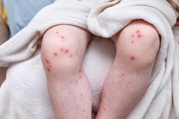 Skin rash on the legs of a small child. Ulcers from scratching. Acute viral disease of coxsackie....