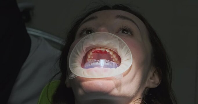 Orthodontist removes red material from teeth to check mouth guard. Close-up, black gloves, dentist's mirror, rubber mouthguard for bite correction.