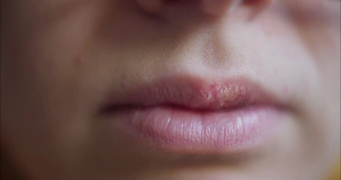 Herpes Sore On Woman's Lips Vesicles
