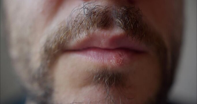 Man With Herpes On Lips