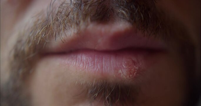 Herpes Sore On Male Lips Vesicles