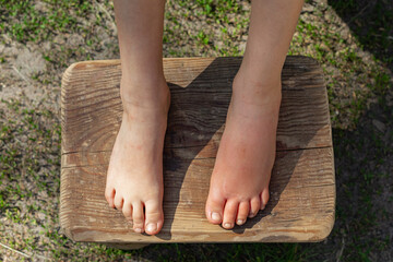 Red and swollen leg of a child girl from a bee sting - obrazy, fototapety, plakaty