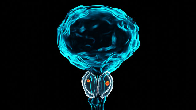 Prostate cancer stages. ancerous cells, malignant tumor compresses urethra. Pathological disruption, genital reproductive system anatomy, bladder Oncological or Urological Disease, bph, 3d render