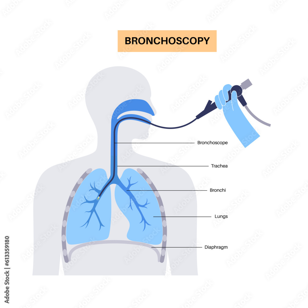 Poster Bronchoscopy procedure concept