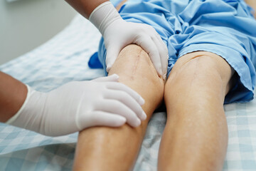 Doctor checking Asian elderly woman patient with scar knee replacement surgery in hospital. - obrazy, fototapety, plakaty