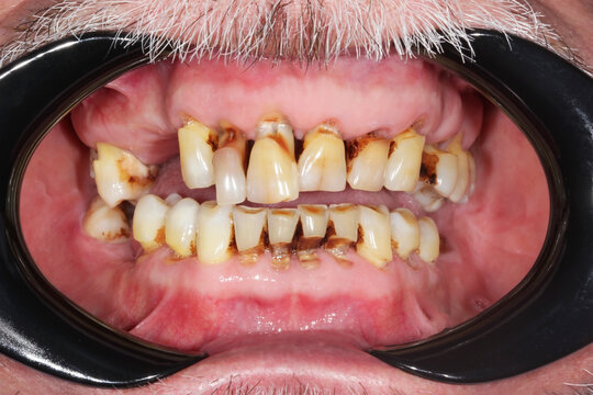 Chronic generalized Paradontitis. Severe Periodontal disease or Periodontitis or severe Gum disease. Dentist office. Wedge-shaped defect. Smoker's plaque.