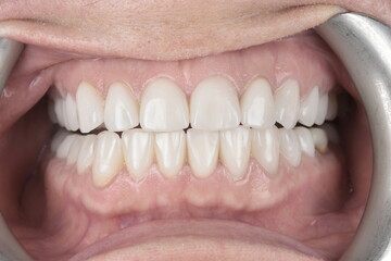 Obraz premium Enchanting Dental Masterpieces: Unveiling Captivating Images of Dental Perfection