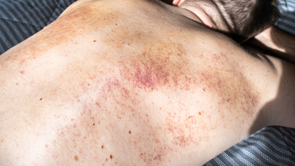 Close up bruises on the back of a man after a massage, treatment of seals and bruises after massage