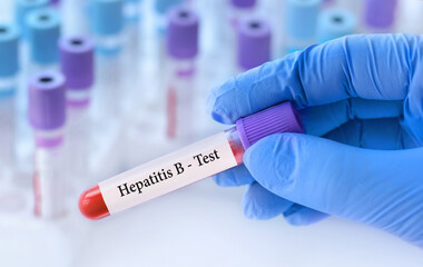 The doctor holds a test blood sample tube with hepatitis B virus (HBV) test on the background of...