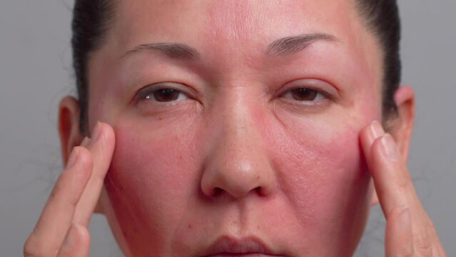 allergies, rosacea, rosacea, redness of the skin, red spots on the cheeks, a woman with sensitive skin, a close-up of the patient's face