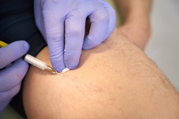 Fototapeta na wymiar Treatment of mesh of veins on inside of thigh male