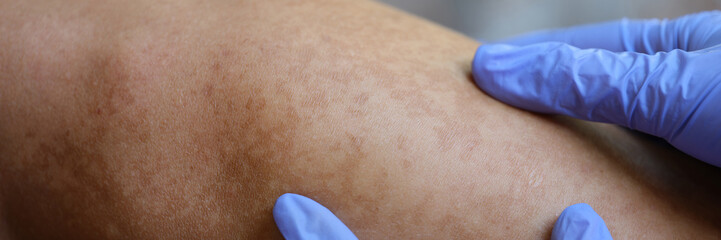 Doctor hands in rubber protective gloves check skin of young man with vitiligo or skin rashes