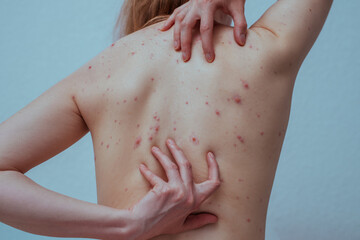 A woman with chicken pox scratches her back