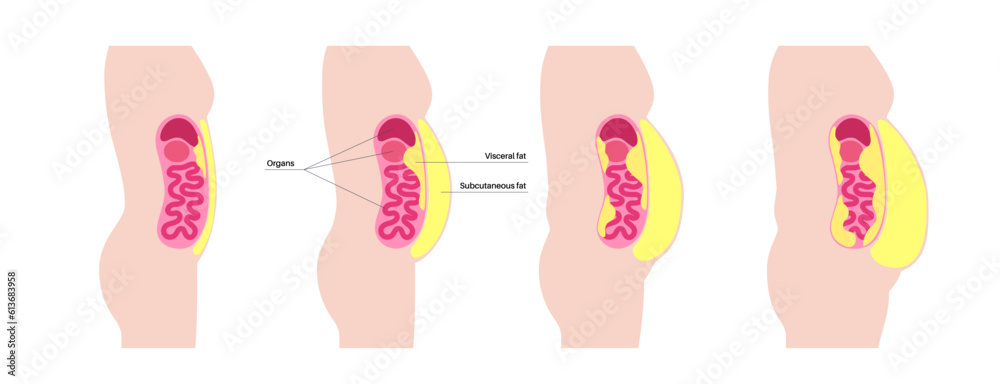 Wall mural Visceral fat diagram