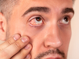 Obraz premium Man shows irritated red bloody eye