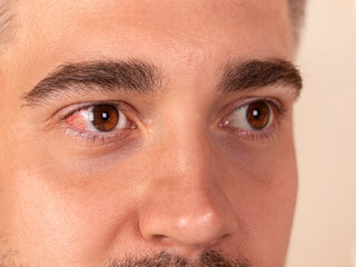 Man with red inflamed eye. Allergic reaction