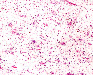 Loose connective tissue. Chronic inflammation