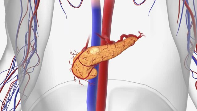 Stage 4 pancreatic Cancer 3d animation