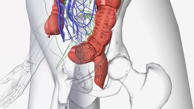 Stage II colorectal cancer is divided into stages IIA, IIB, and IIC. In stage IIA, cancer has spread through the muscle layer of the colon and or rectum