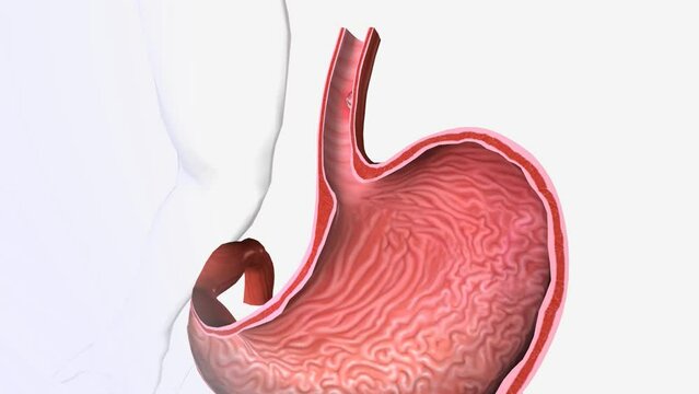 Esophageal Squamous Cell Carcinoma 3d