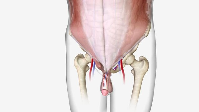 Indirect inguinal hernia: An indirect inguinal hernia enters your inguinal canal through the top