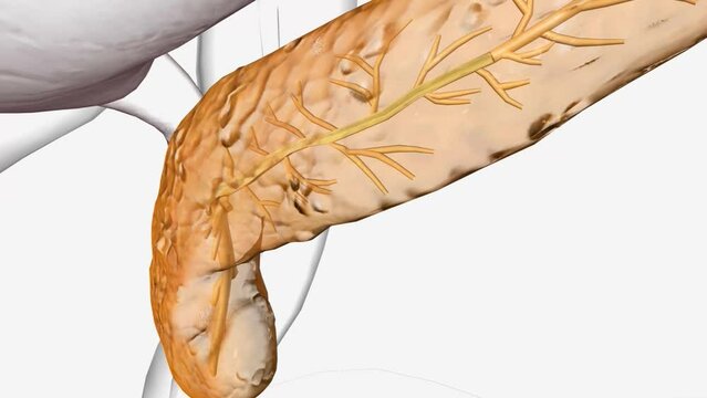 Cystic Fibrosis in Pancreas 3d