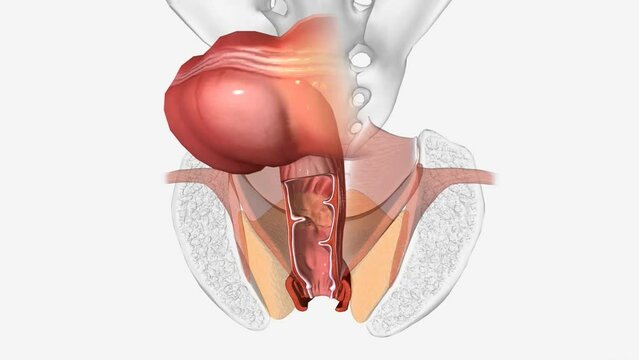 Fecal incontinence, also called accidental bowel leakage, is the accidental passing of solid or liquid stools from your anus