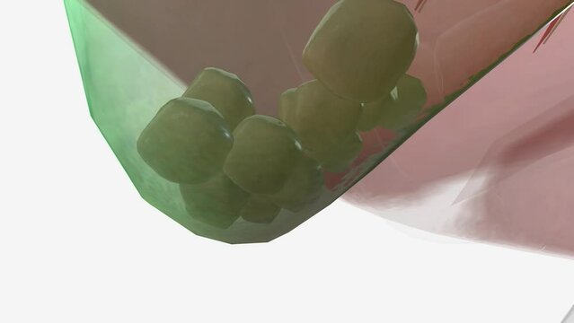 Cholelithiasis or gallstones are hardened deposits of digestive fluid that can form in your gallbladder.