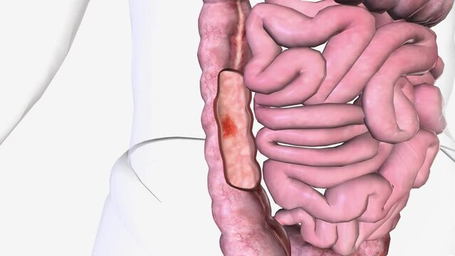 Angiodysplasia is an abnormal, tortuous, dilated small blood vessel in the mucosal and submucosal layers of the GI tract.