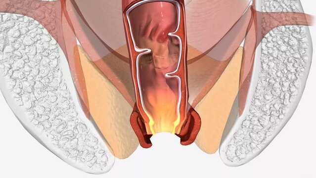 Fecal incontinence, also called accidental bowel leakage, is the accidental passing of solid or liquid stools from your anus