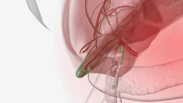 Cholelithiasis or gallstones are hardened deposits of digestive fluid that can form in your gallbladder.