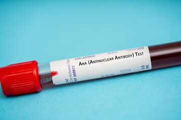 Ana (Antinuclear Antibody) Test